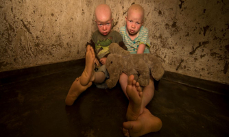 Personnes atteintes d’albinisme